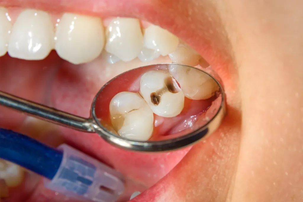 Signs Your Dental Filling Needs to Be Replaced